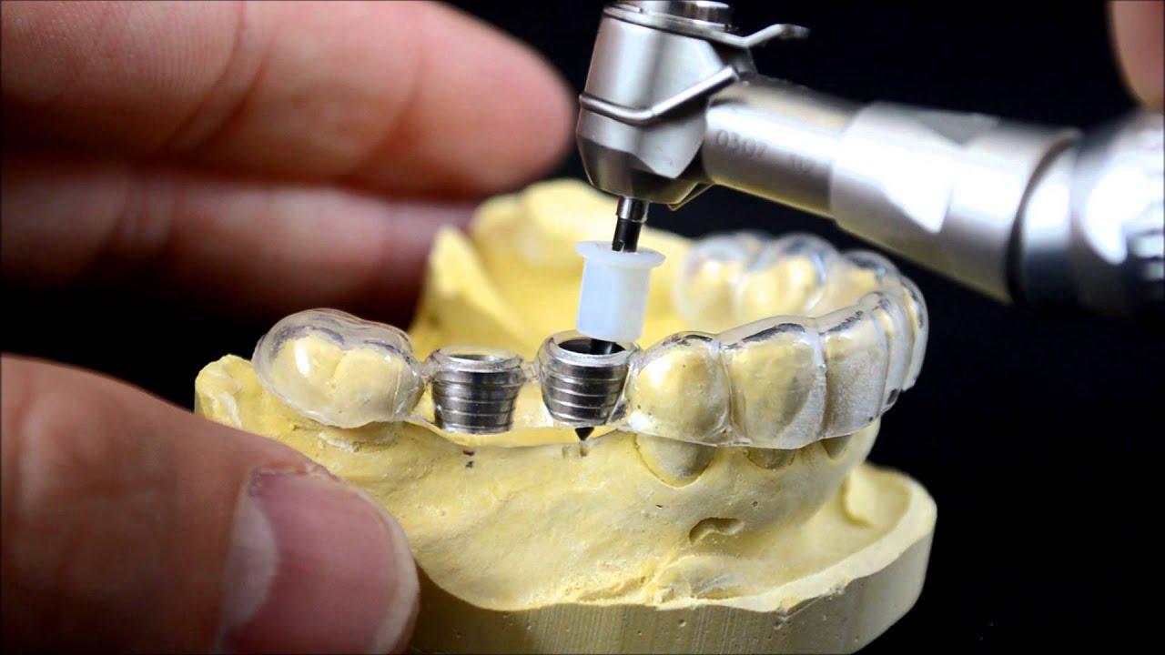 Orthodontic Surgical Guides